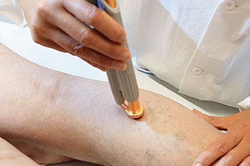 Prendre en charge les varices sans chirurgie invasive